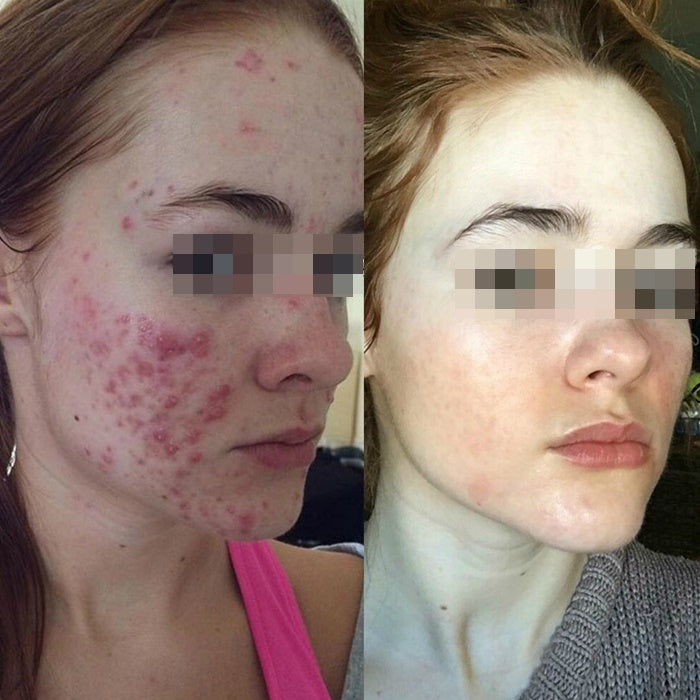 Tira borbulhas e manchas no rosto - Acne - não clareia - Beauty skin - Embalagem de 4 frascos