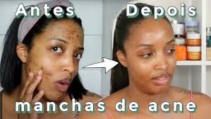 Tira borbulhas e manchas no rosto - Acne - não clareia - Beauty skin - Embalagem de 4 frascos